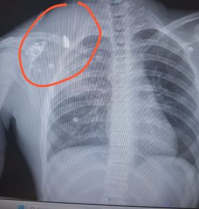 צילום רנטגן של הקליע בגופו של הנער שנפצע בבנימין